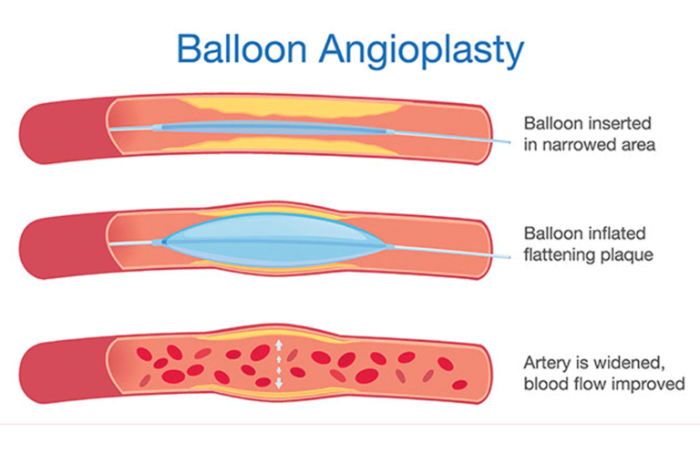 Billion-Angioplasty