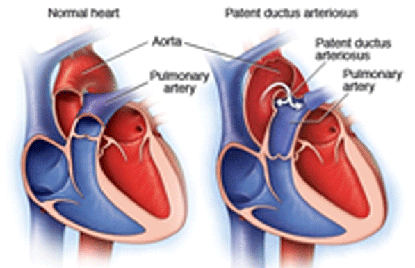 CARDIAC-SHUNTS-01