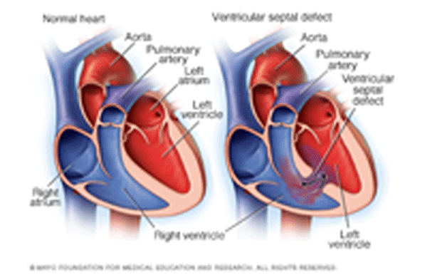 CARDIAC-SHUNTS-02