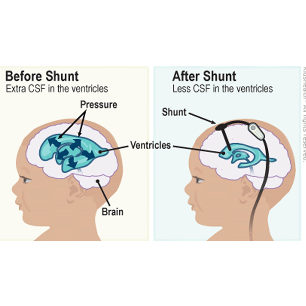 Hydrocephalus-before